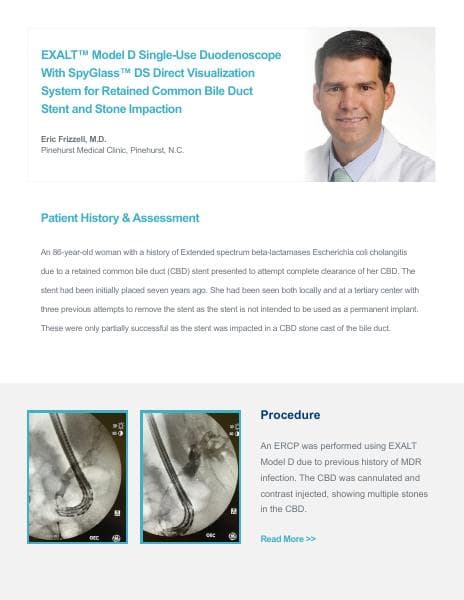 EXALT_D_Case_Study_Dr_Frizzell