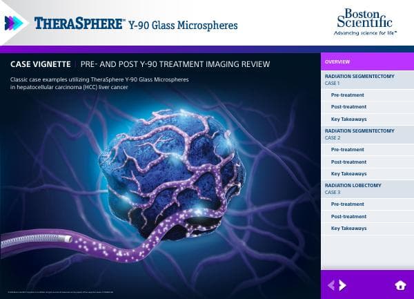 TheraSphere_imaging_case_vignette